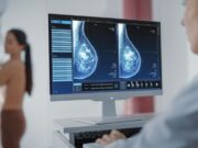La SECA lidera una iniciativa per optimitzar l’abordatge del càncer de mama precoç